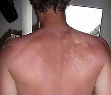 Image result for Full Body SunBurn