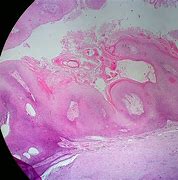 Image result for Verrucous Papilloma