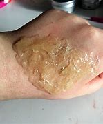 Image result for 3rd Degree Burn Patient