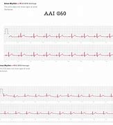Image result for Low Voltage ECG Apple Watch