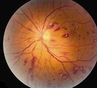 Image result for White Spots On Retina