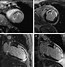 Image result for MRI Imaging Myocardial Infarction