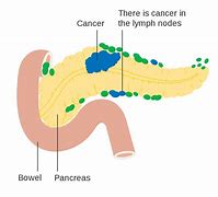 Image result for Pancreatic Cancer Pathophysiology