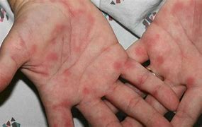 Image result for Small Red Dots On Hands