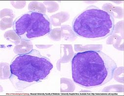 Image result for Mycosis Fungoides Sezary Syndrome