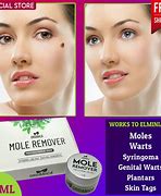 Image result for Cream for Mole Removal