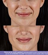Image result for Chin Line While Smiling