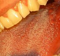 Image result for Large Bumps On Back of Tongue