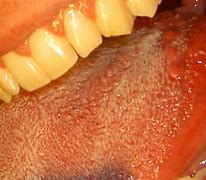 Image result for Bump/Blister Side of Tongue Papilloma
