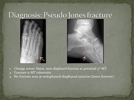 Image result for Pseudo-Jones Fracture