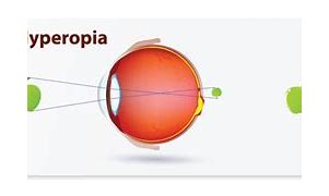 Image result for Hyperopia Lens