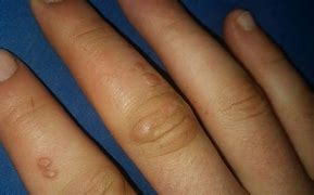 Image result for Different Types of Warts