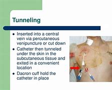 Image result for Bard Tunneled PICC