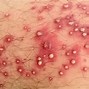 Image result for Leukemia Rash Symptoms in Adults