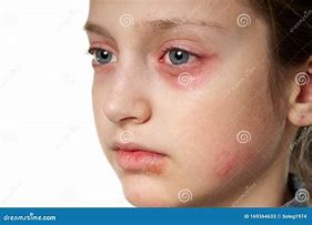 Image result for Allergic Dots