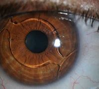 Image result for Phakic Intraocular Lens