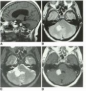 Image result for Choroid Plexus Papilloma and Foramen of Magendie