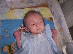 Image result for Oldest Person with Trisomy 18