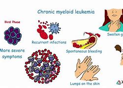 Image result for Chronic Myeloid Leukemia Symptoms