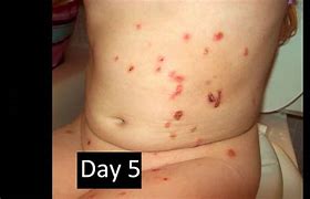 Image result for Molluscum Contagiosum Healing Stages