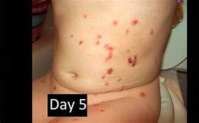 Image result for Molluscum Contagiosum After Treatment