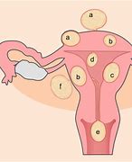 Image result for Fibroid Tumors in Uterus
