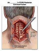 Image result for Posterior Cervical Fusion Surgery