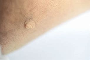 Image result for Pedunculated Skin Mass