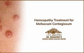 Image result for Molluscum Contagiosum Before and After