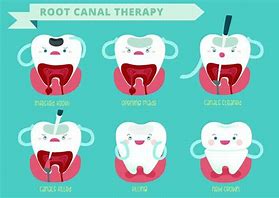 Image result for Root Canal Cartoon