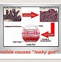 Image result for Leaky Gut and Candida