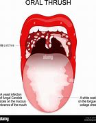 Image result for Papilloma On Tongue