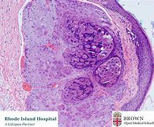 Image result for Molluscum Contagiosum Diagnostic Criteria