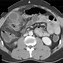 Image result for Gallbladder Mass CT