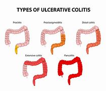 Image result for colitis_ulcerosa
