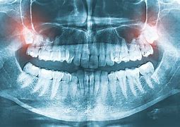 Image result for Wisdom Teeth Upper Jaw
