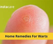 Image result for Warts On Kid's Hands