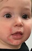Image result for Toddler Face Rash around Mouth