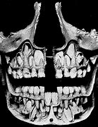 Image result for Toddler Skull Teeth