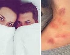 Image result for How to Get Rid of Love Bites
