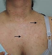 Image result for People with Epidermodysplasia Verruciformis