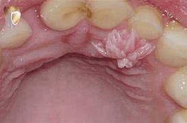 Image result for Squamous Cell Papilloma On Cheek