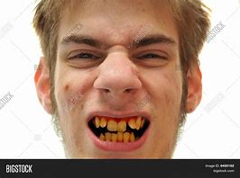 Image result for Bad Yellow Teeth