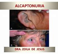 Image result for alcapronuria