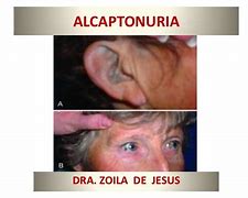Image result for alcaptonuris