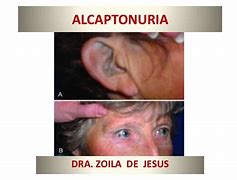 Image result for alcaptonuria