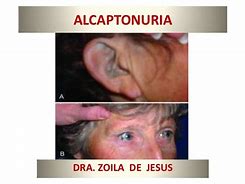 Image result for alcaptomuria