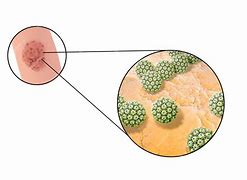 Image result for HPV Lesions in Men