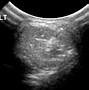 Image result for Orbital Dermoid Cyst