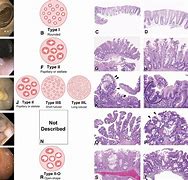 Image result for 4Mm Polyp in Colon